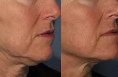 Skin Tightening Options, Compared