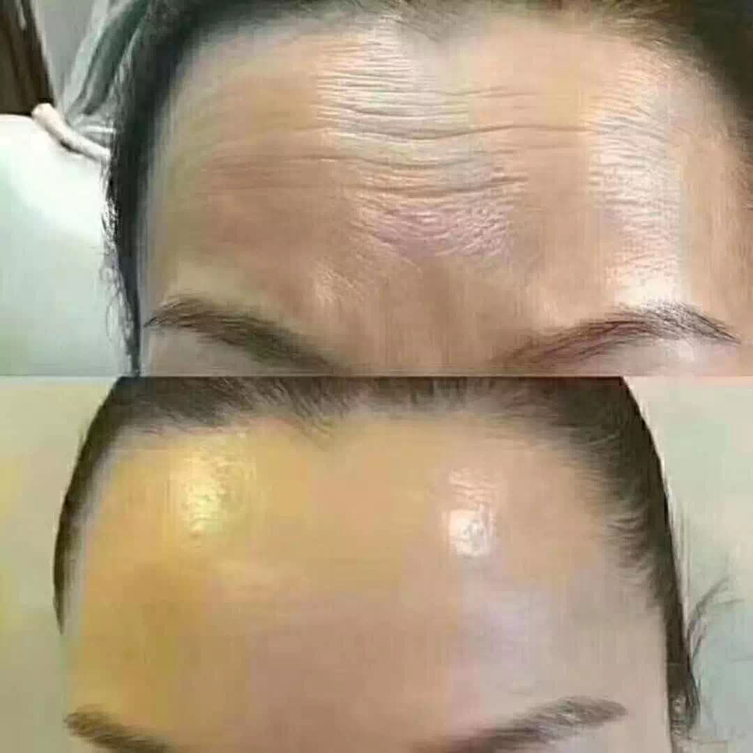 Anti-Wrinkle Treatment