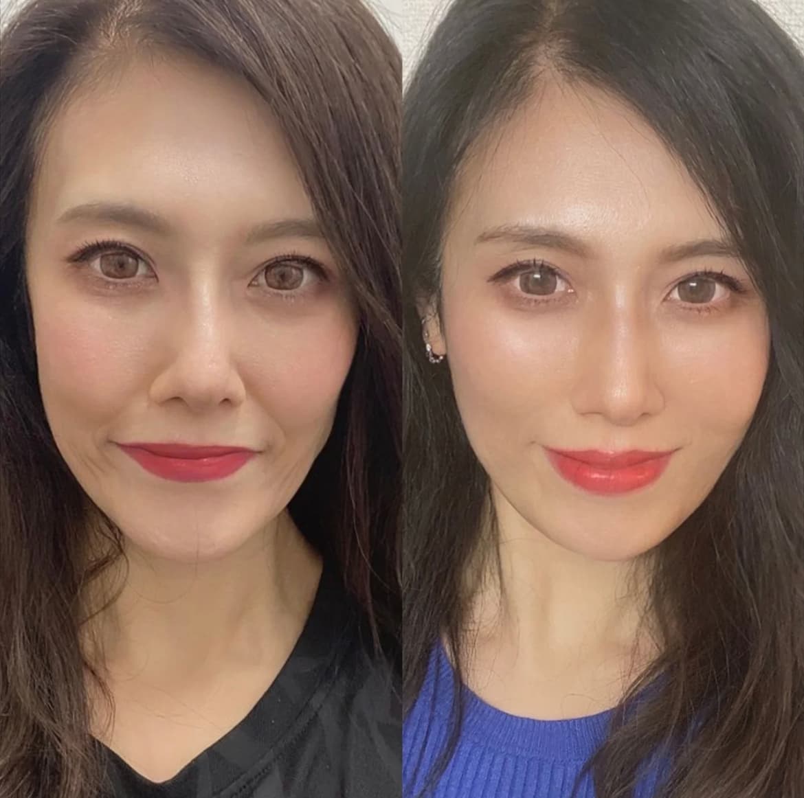 Full Facial Rejuvenation