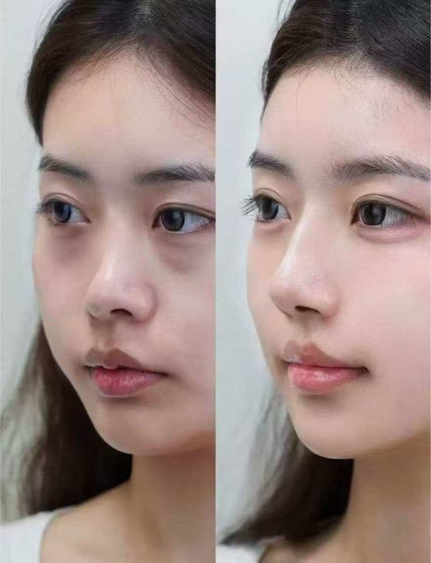Non-Surgical Nose Refinement